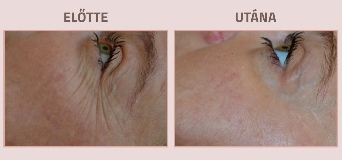 Exilis-Ultra-360-elotte-utana-arc