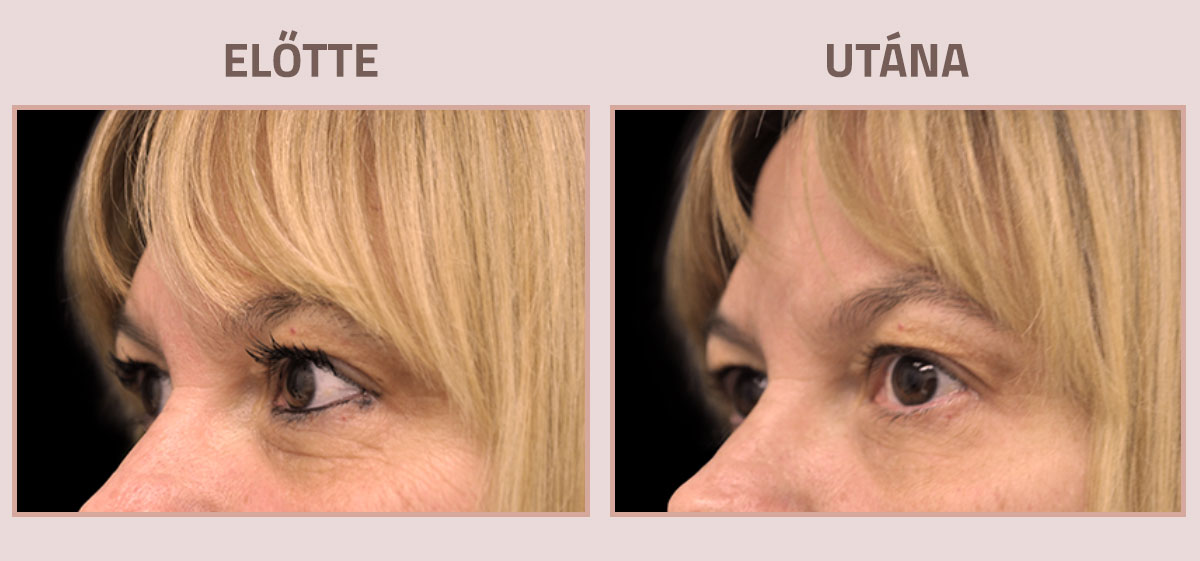 Exilis-Ultra-360-elotte-utana-arc2