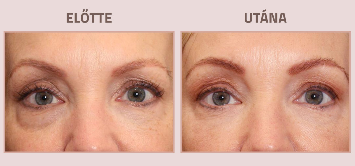 Exilis-Ultra-360-elotte-utana-arc3