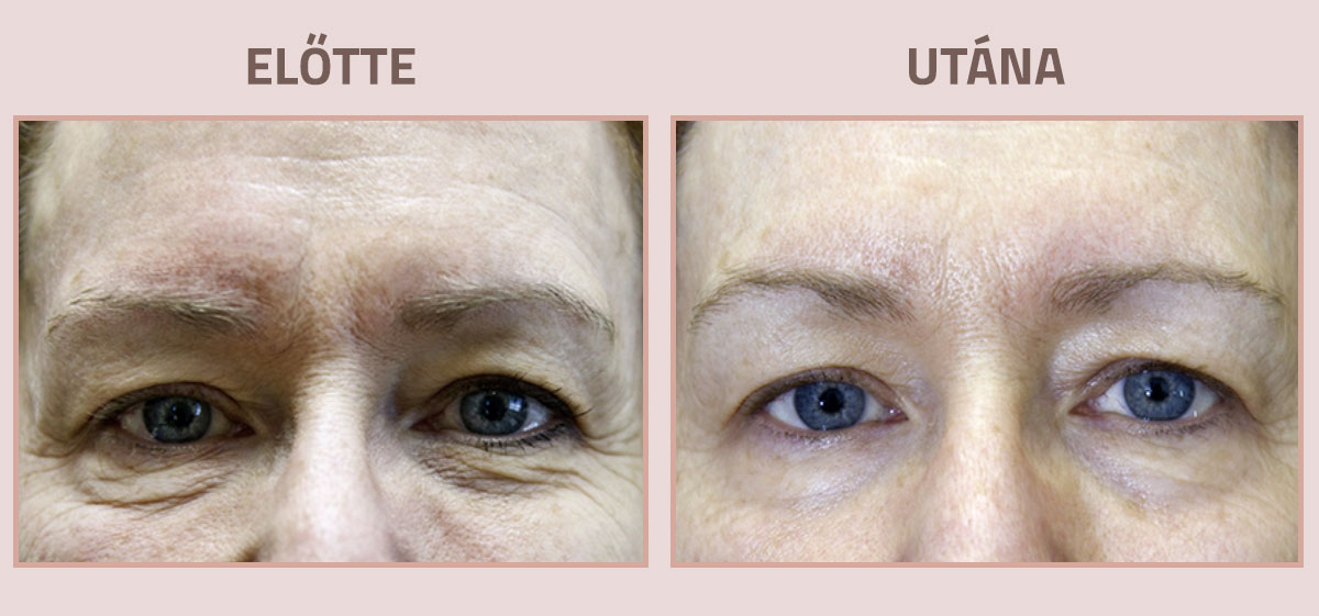 Exilis-Ultra-360-elotte-utana-arc4