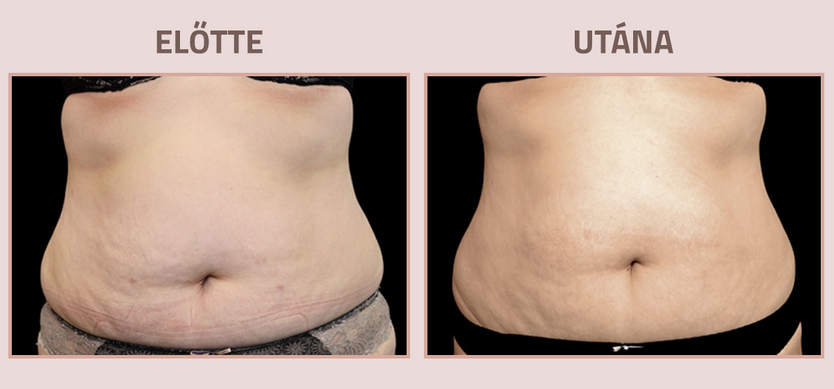 Exilis-Ultra-360-elotte-utana-has