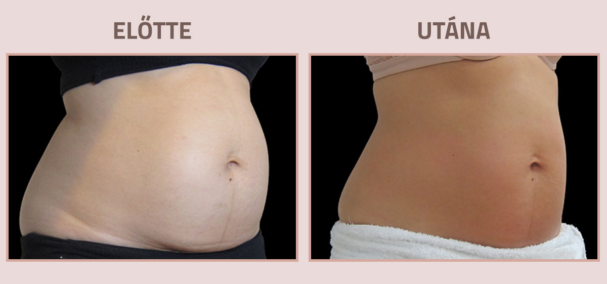 Exilis-Ultra-360-elotte-utana-has2
