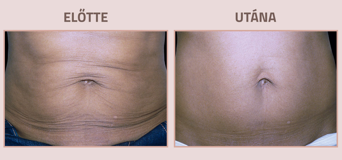 Exilis-Ultra-360-elotte-utana-has3