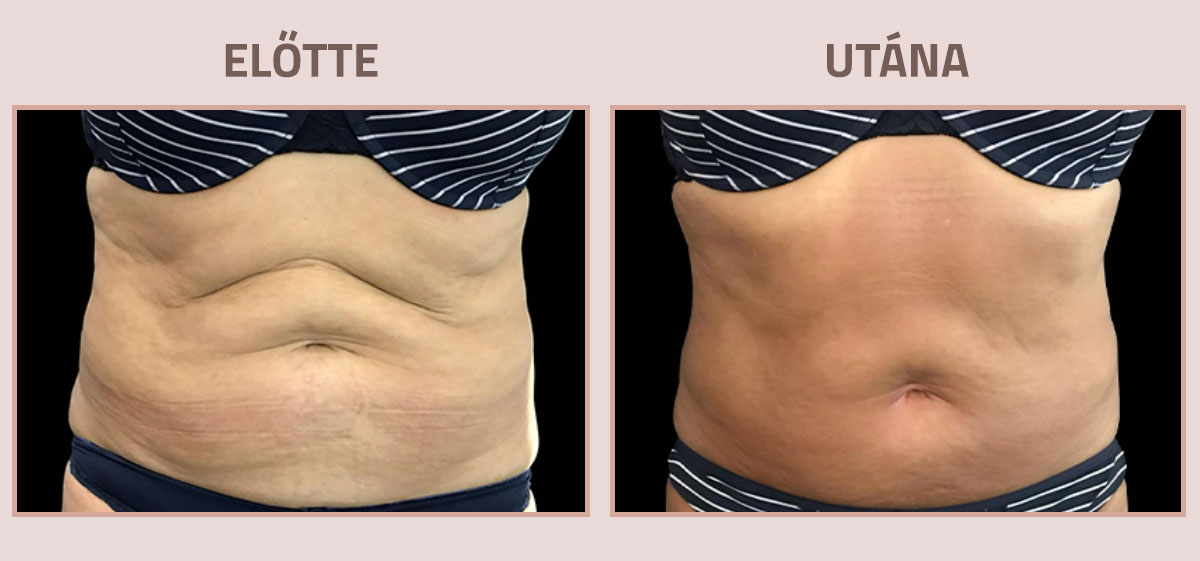 Exilis-Ultra-360-elotte-utana-has4