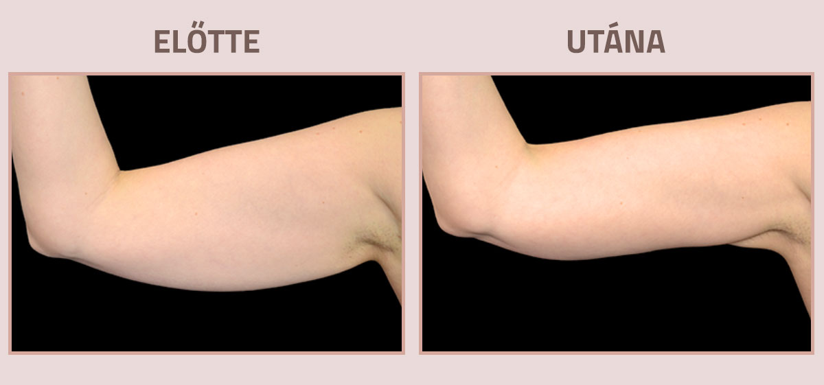 Exilis-Ultra-360-elotte-utana-kar