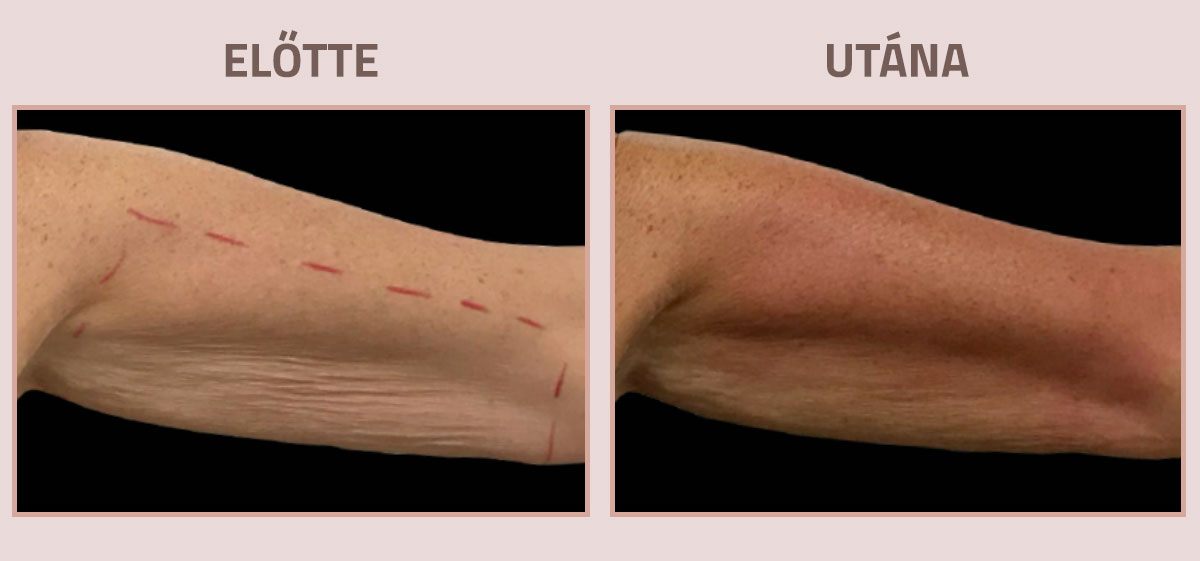 Exilis-Ultra-360-elotte-utana-kar2