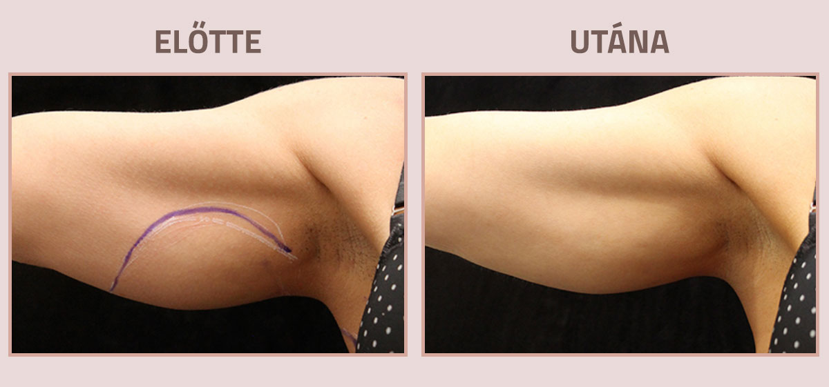 Exilis-Ultra-360-elotte-utana-kar3