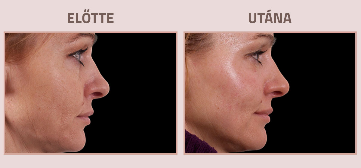 Exilis-Ultra-360-elotte-utana-nyak3