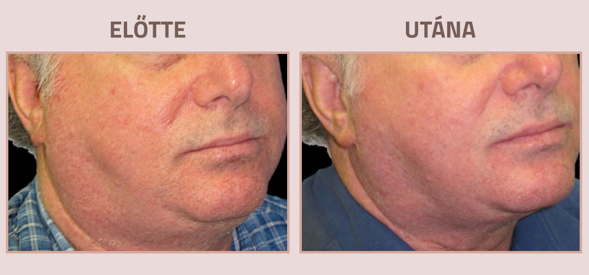 Exilis-Ultra-360-elotte-utana-nyak4