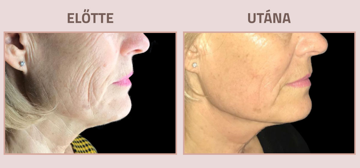 Exilis-Ultra-360-elotte-utana-nyak5