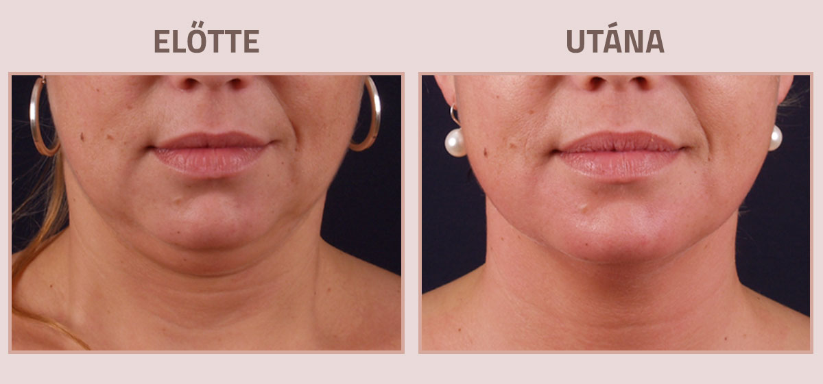 Exilis-Ultra-360-elotte-utana-nyak6